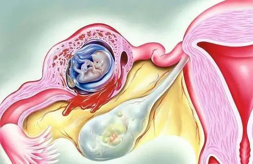 高龄试管婴儿取得多少卵子合适，试管婴儿有可能得到双胞胎吗